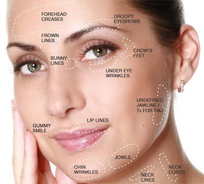 Dermal Fillers