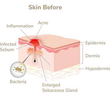 Ivory Light Therapy Image 1