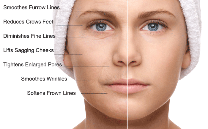 Microneedling