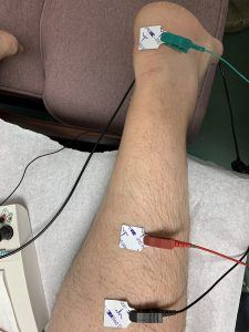 NCV – Nerve Conduction Velocity