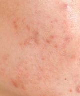 Do Acne Scar Treatments Actually Work?