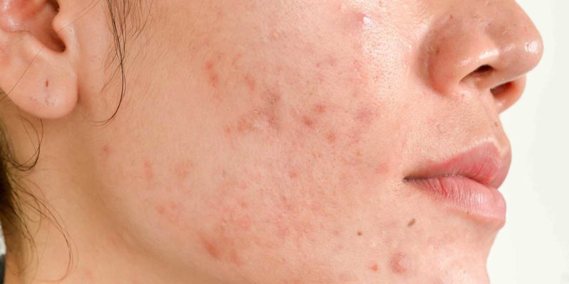 Do Acne Scar Treatments Actually Work?